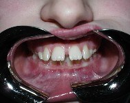 svegliamento dentale